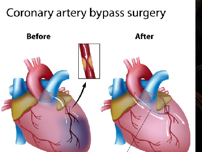 Coronary Artery Bypass Graft In Middle East